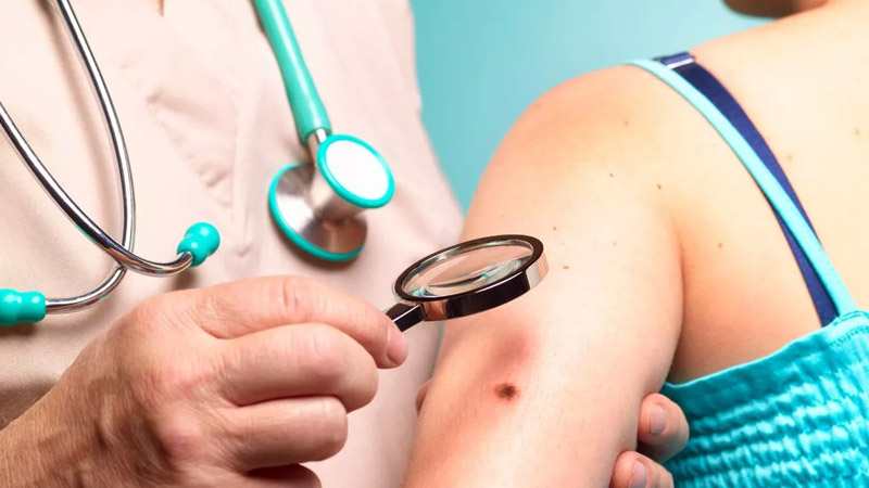  Doctors Reveal Five Major ‘Red Flags’ That Indicate a Potentially Cancerous Skin Mole