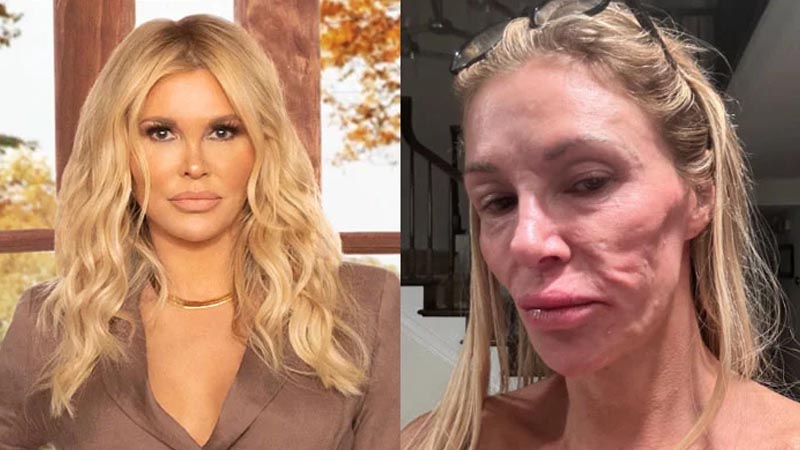  Brandi Glanville reveals the reason behind her shocking facial disfigurement: ‘Some Doctors Say I Have a Parasite’